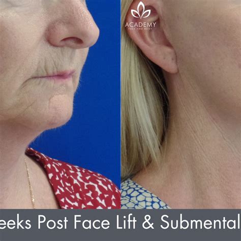 Facelift Perth MACS Lift Surgery Academy Face Body