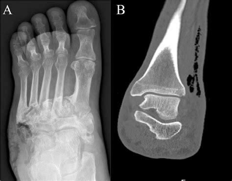 Anatomic And Treatment Descriptive Features Of Foot Infections