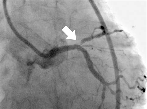 Optimal C Arm Angle During DCA By Linking 3DCT And Angiography Systems