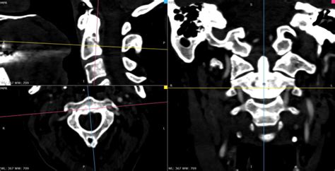 Surgicoanatomical Aspect In Vascular Variations Of The V3 Segment Of Vertebral Artery As A Risk