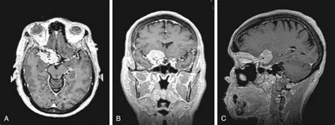 Sphenoid Wing Meningiomas Clinical Tree