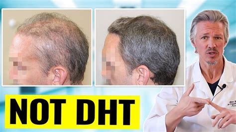 Inflammatory Hair Loss Day Results See What Can Happen When You