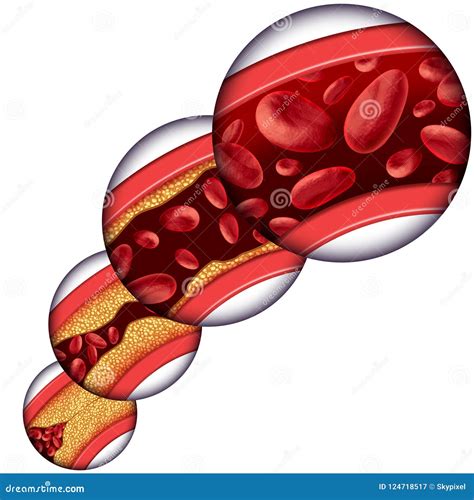 Coronary Artery Cholesterol Therapy Stock Illustration - Illustration ...