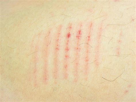 Close Up Scar Scratch On The Human Body Stock Photo At Vecteezy