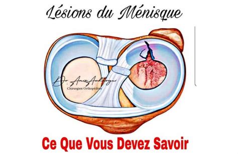 Tout savoir sur les lésions du Ménisque Docteur Anis ACHARGUI