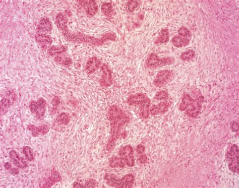 Mammary Gland Pathology Ii Mammary Masses Including Neoplasia