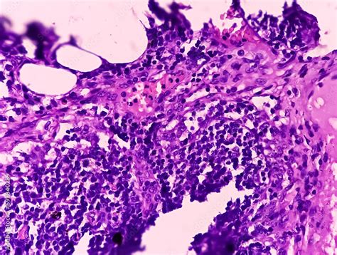 Thyroid Cancer Tracheal Gland Involved By Tumor Microscopic Image Of