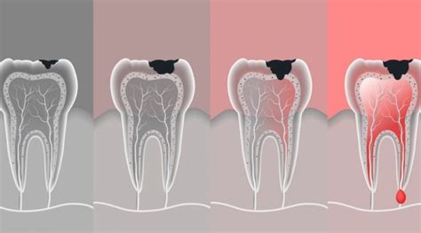 C Mo Prevenir Las Caries Dentales Salud Dental Con La Dr Bernarda