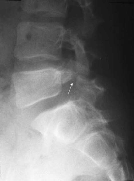 Spondylosis X Ray