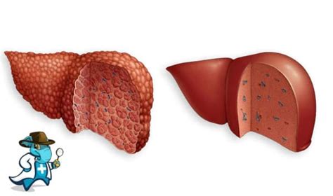 Cubre el Seguro Médico la Cirrosis Hepática en España