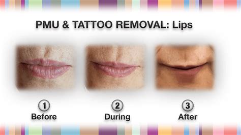 Permanent Makeup & Tattoo Removal - NPM Shop