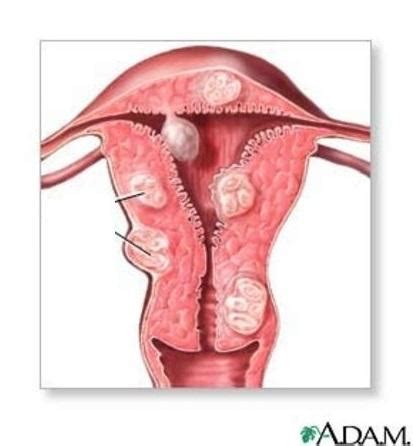 Cuáles son los síntomas de un mioma uterino 7 pasos