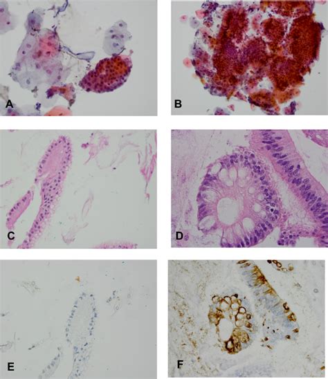 Combined EsophaCap Cytology And MUC2 Immunohistochemistry For Screenin