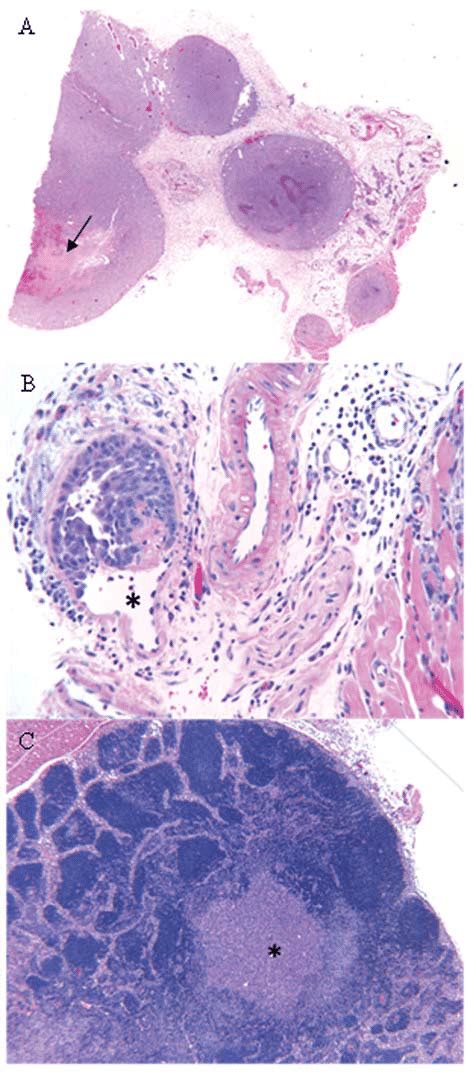 Histopathology Hematoxylin And Eosin Sections Showing A Tumor At The