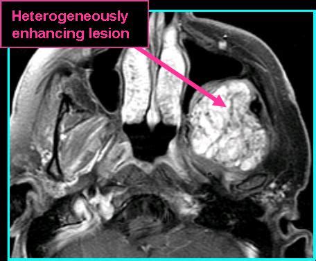 Chondrosarcoma - Radiology | Iowa Head and Neck Protocols