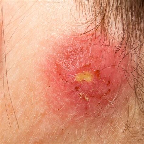 5 Common Contagious Skin Diseases And Infections