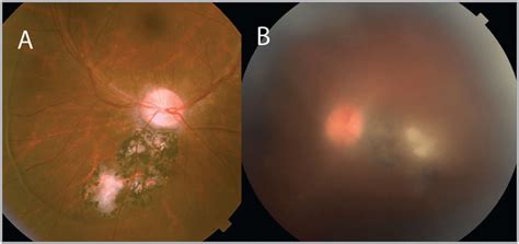 Typical Retinochoroidal Lesions Seen In Toxoplasmosis A