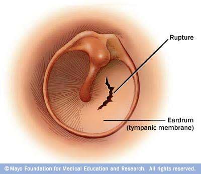 Ruptured eardrum (perforated eardrum) Disease Reference Guide - Drugs.com