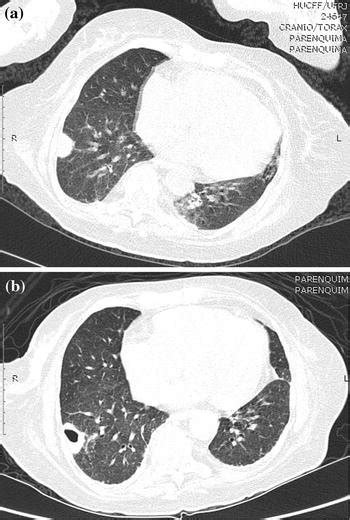 a Thoracic computed tomography (CT) scan showing a subpleural nodule ...