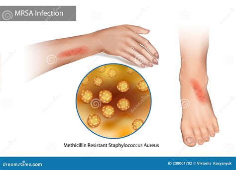 MRSA Superbug Infection Methicillin Resistant Staphylococcus Aureus