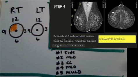 How To Read A Mammogram YouTube