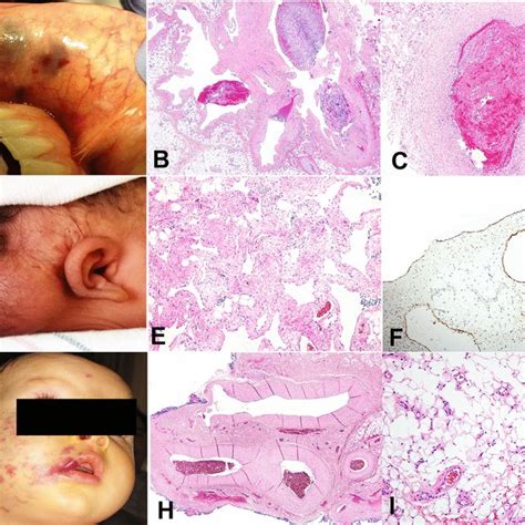 Flat Topped Or Dome Shaped Violaceous Or Purpuric Papules And Plaques Download Scientific