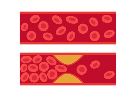 artère normale et bloquée par le cholestérol caillot sanguin thrombus