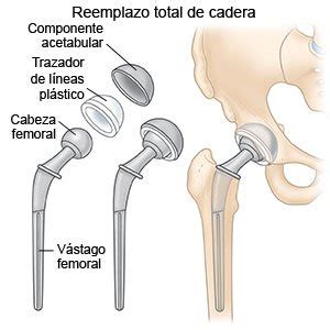 Reemplazo De Cadera Anterior Discharge Care Care Guide Information En