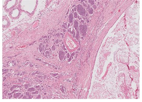 A Pre Pubertal Type Teratoma With And Area Of Low Grade Neuroendocrine