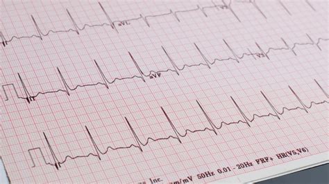 O que é o eletrocardiograma ECG e como funciona Life Laudos