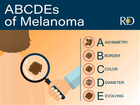 Melanoma and Early Detection - Revival Dermatology l Dallas Dermatology ...