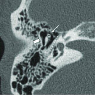 Axial CT image in a normal temporal bone study (0.1 mm, bone ...