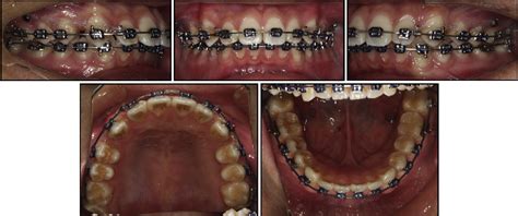 Figure From Severe Class Ii Division Malocclusion In An Adolescent