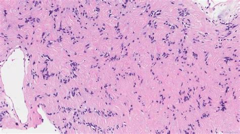 Nuclear Palisading Archives Atlas Of Pathology