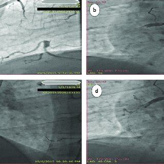 Steps of procedural intervention: (a) LAD with patent stent gives off... | Download Scientific ...