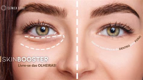 Livre Se Das Olheiras Conheça O Skinbooster Preenchimento Clínica