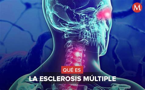 Esclerosis Lateral Amiotrófica Factores De Riesgo Y Tratamiento Grupo Milenio