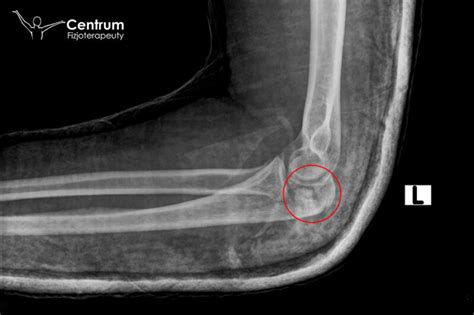 Złamanie nasady bliższej kości łokciowej Centrum Fizjoterapeuty