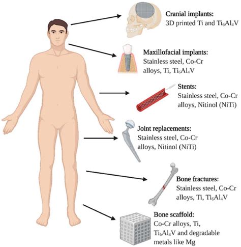 Kinds Of Metallic Implants Utilized In The Human Body Reprinted With