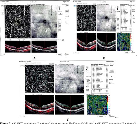 Figure 2 From Correlations Between Optical Coherence Tomography