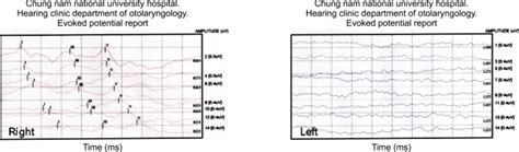 Patient 1 Shows Normal Auditory Brainstem Response Abr On The Right Download Scientific