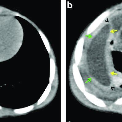 Tomodensitométrie thoracique en coupe axiale en fenêtre médiastinale