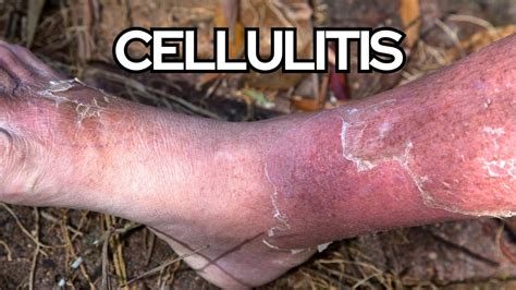 Understanding Cellulitis In Seniors Risks Complications And Prevention Strategies Youtube