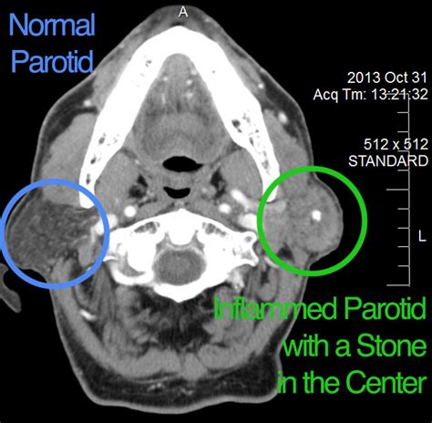 Diagnosis Of Parotid Conditions Dr Larian