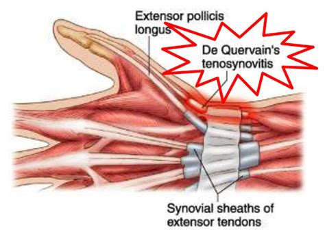 De Quervains Tenosynovitis Treatment De Quervains Tenosynovitis