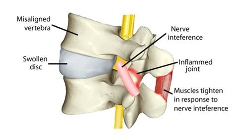 Subluxation -Turning Point Chiropractic - Saratoga Springs, NY Chiropractor