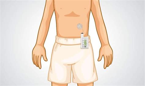 Insulin Pump Therapy For Type 2 Diabetes Agva Healthcare