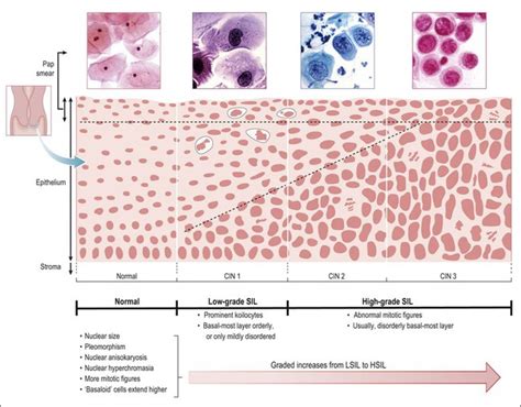 Cervical Dysplasia Stages And Pap Smear Test Poster Zazzle Ph