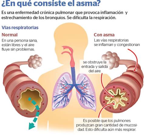 El asma sí se puede controlar y vivir bien