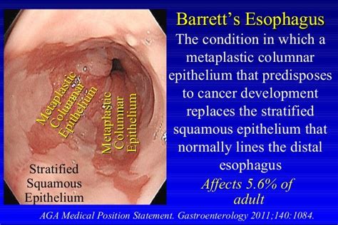 Stages Of Barrett's Esophagus